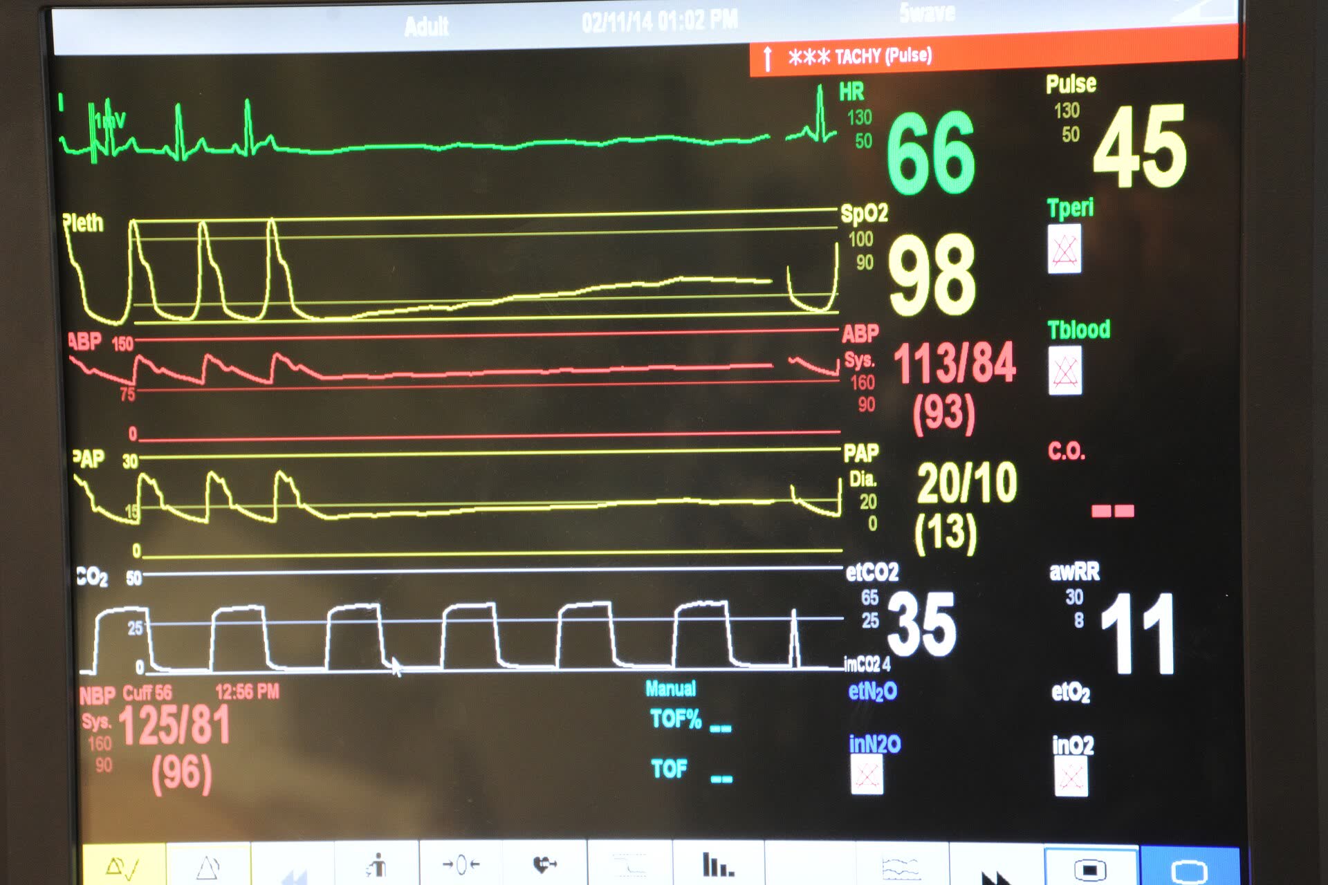 Bedside monitor showing a patient's heart rate, oxygen and blood pressure